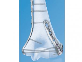 VA-LCP of distal humerus: image from Depuy-Synthes
